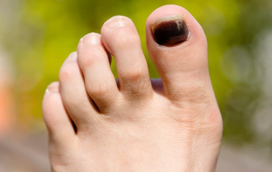 Black Toenail Fungus-Know the Causes, Treatment and Home Remedies