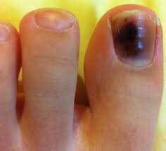 Black toenail cancer or melanoma