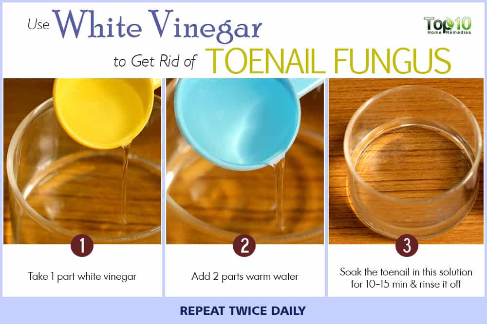 how-to-get-rid-of-toenail-fungus-white-vinegar-water